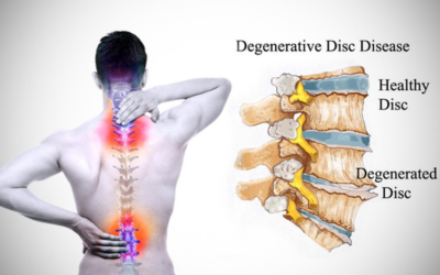 Degenerative_Joint_Disease