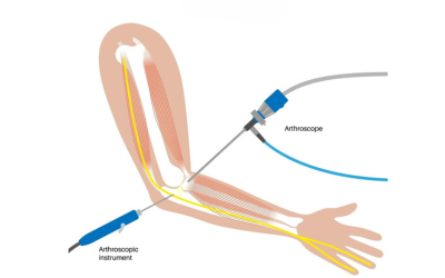 Elbow_Joint_Replacement_Surgery