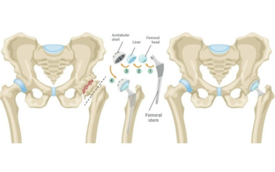 Hip Joint Replacement Surgery