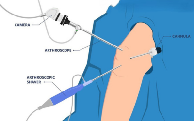 Knee_Joint_Replacement_Surgery