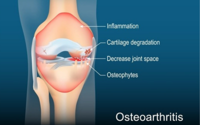 Osteoarthritis