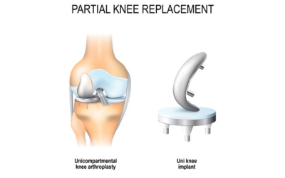 Partial_Joint_Replacement