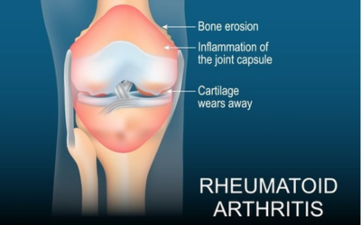 Rheumatoid_Arthritis