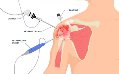 shoulder_joint_replacement_surgery