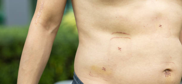 Benefits of Hip Replacement Surgery