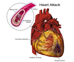 After-Effects of a Heart Attack - Healing Touch Nursing Home