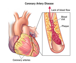 Blocked or Narrowed Heart Arteries - Healing Touch Nursing Home