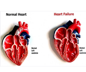 Heart Failure - Healing Touch Nursing Home