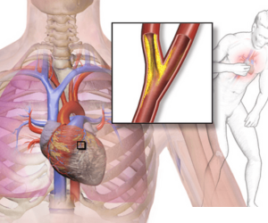Repeated Chest Pain - Healing Touch Nursing Home