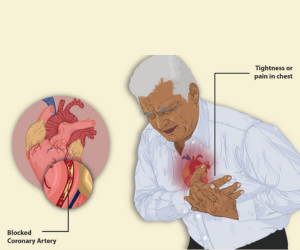 Unstable Angina - Healing Touch Nursing Home